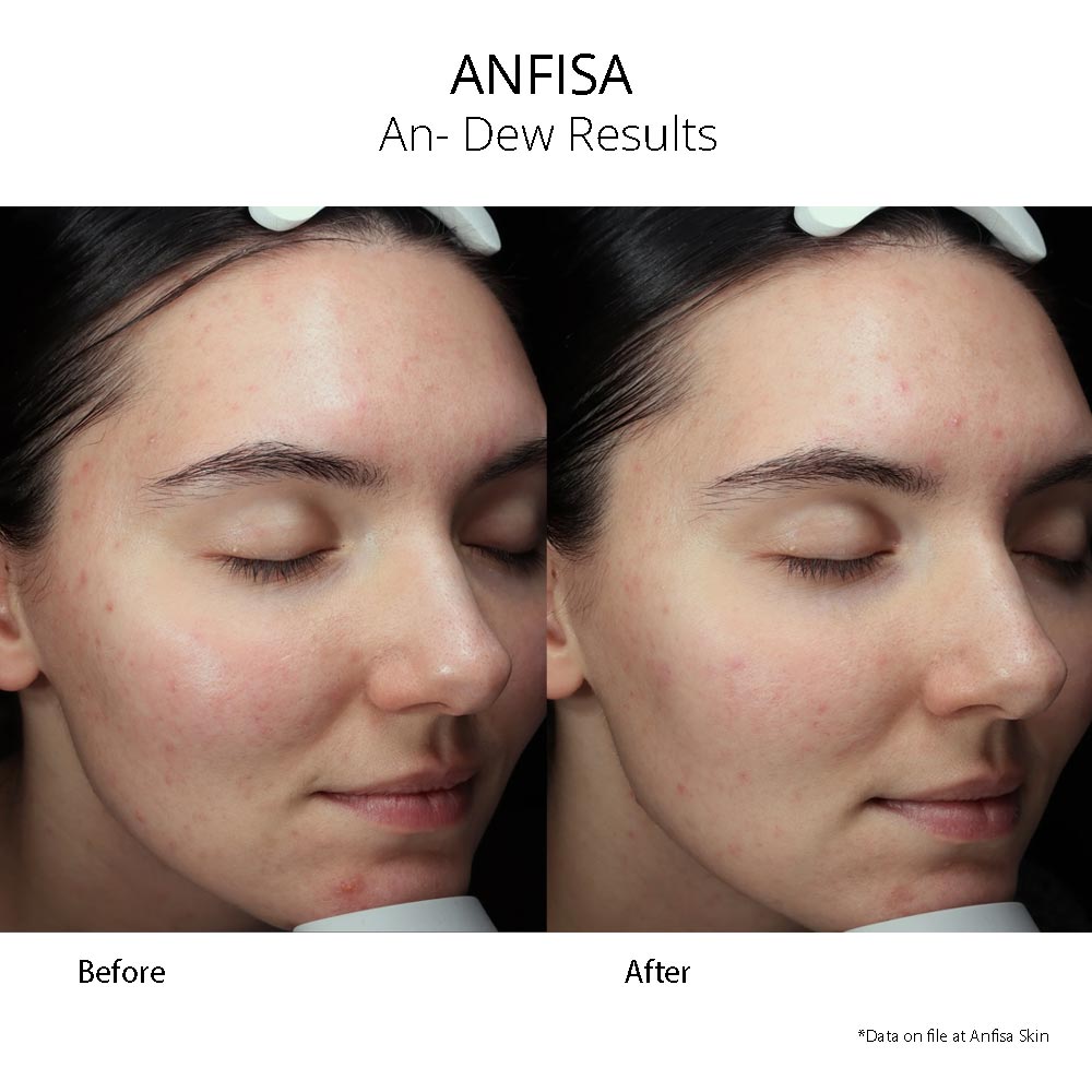 anfisa ân - dew 10% azelaic acid and pha serum - your skincare source