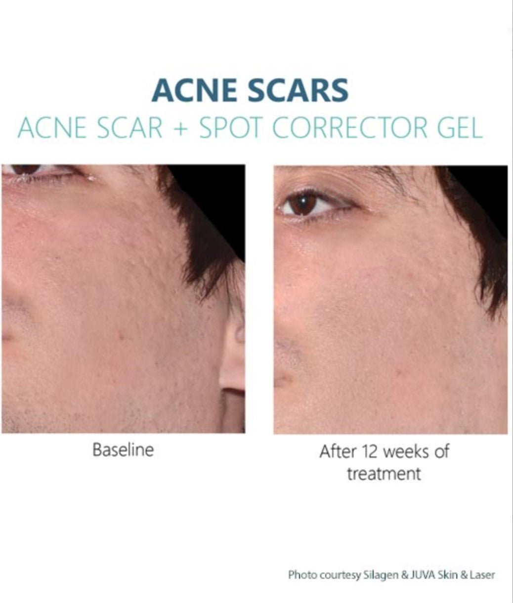 Silagen Acne Scar Refinement + Spot Corrector 30g - Your Skincare Source